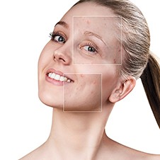 Acne Treatment Program