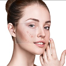 Causes & Risk Factors for Acne