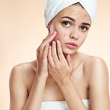 Acne Myths & Misconceptions